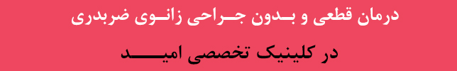 زانوی ضربدری