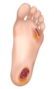 diabetic-foot-wounds